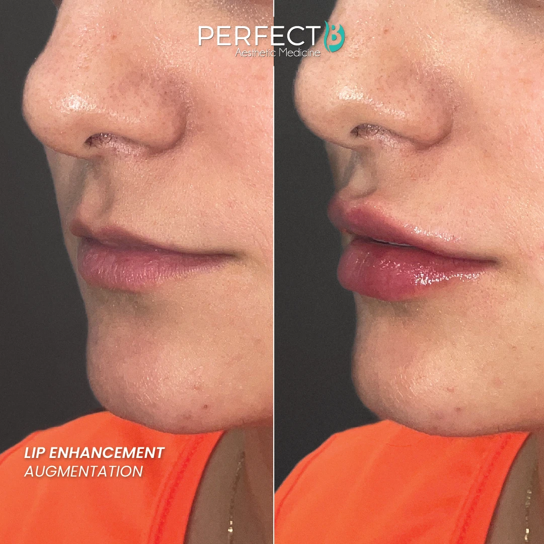 Lip Enhancement Augmentation - Perfect B - Results Image - Case 7463 - 1080 x 1080