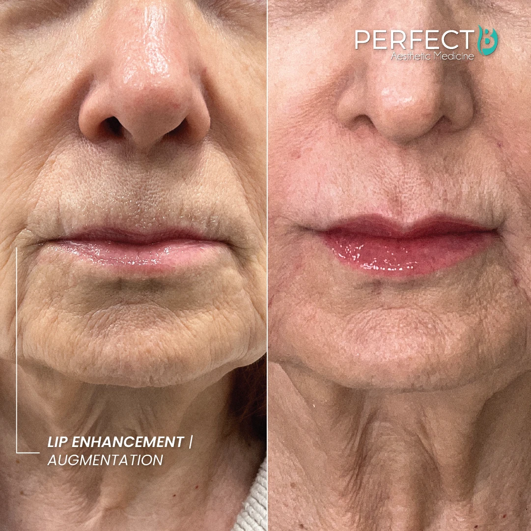 Lip Enhancement / Augmentation Treatment - Case 5033 - Results Image - 1080 x 1080
