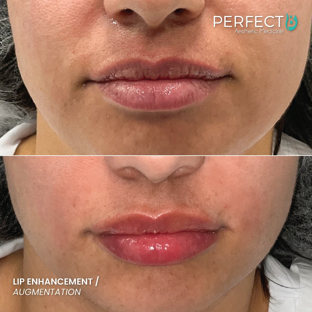 Lip Enhancement Treatment - Perfect B - Results Image - Case 7467 - 1080 x 1080