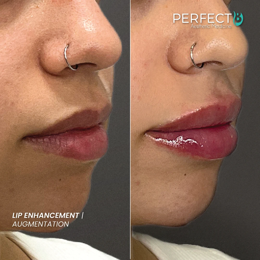 Lip Enhancement Treatment - Perfect B - Results Image - Case 7468 - 1080 x 1080