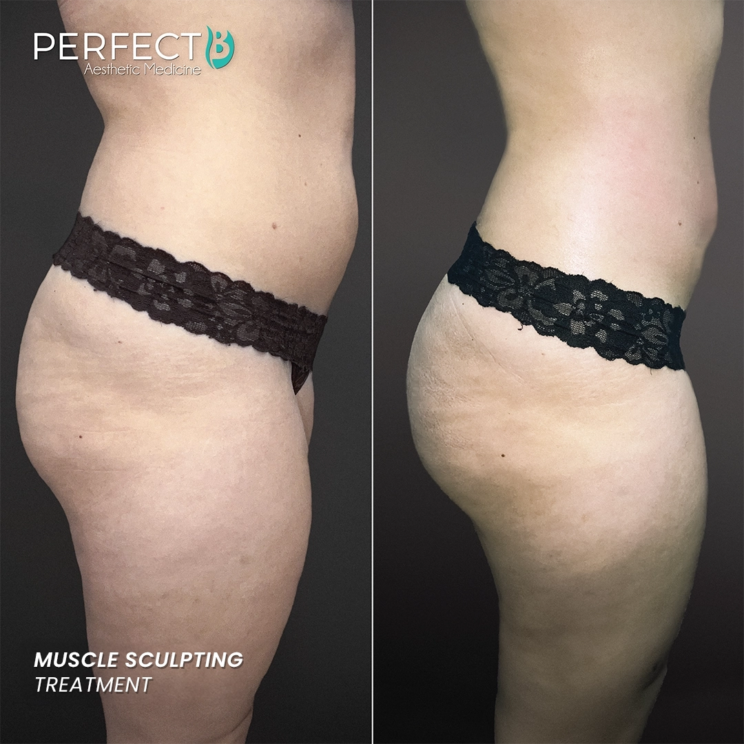 Muscle Sculpting Treatment - Perfect B - Results Image - Case 8023 - 1080 x 1080