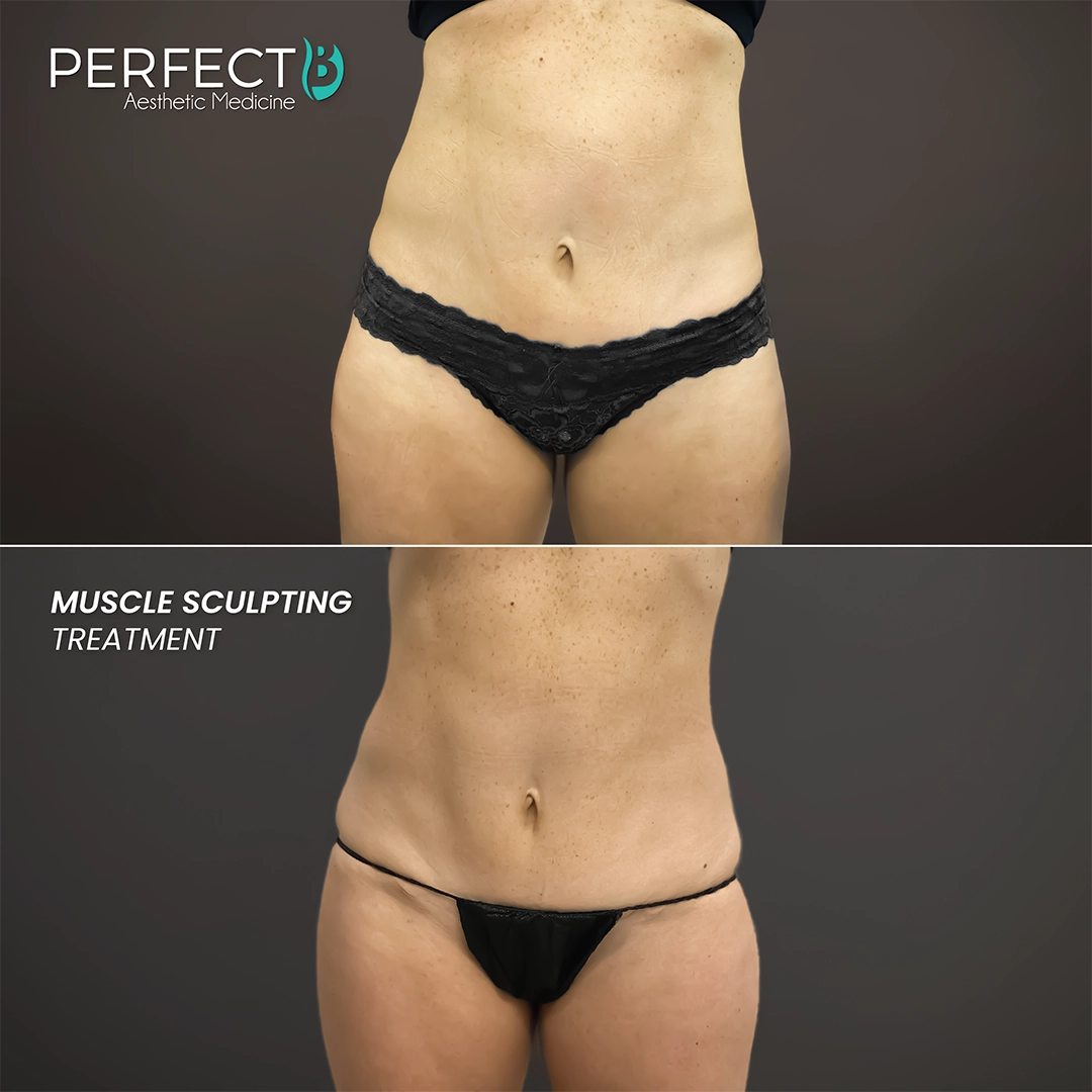 Muscle Sculpting Treatment - Perfect B - Results Image - Case 8236 - 1080 x 1080