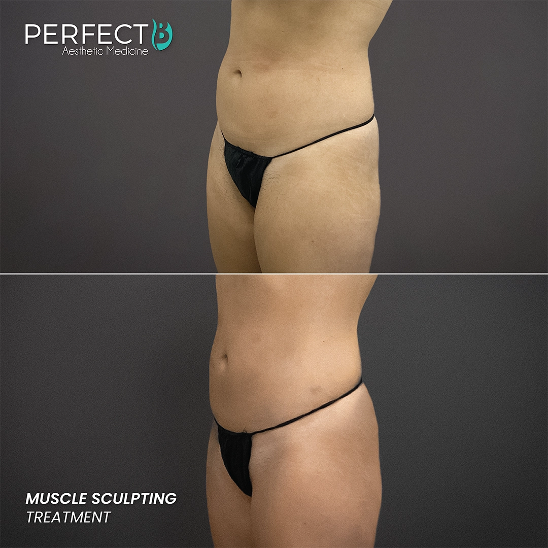 Muscle Sculpting Treatment - Perfect B - Results Image - Case 8250 - 1080 x 1080