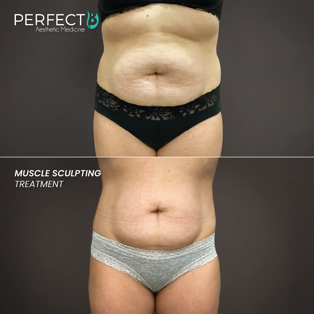 Muscle Sculpting Treatment - Perfect B - Results Image - Case 8252 - 1080 x 1080