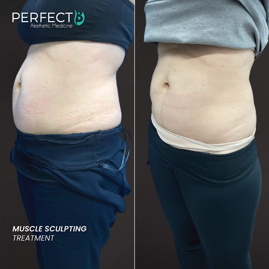 Muscle Sculpting Treatment - Perfect B - Results Image - Case 8212 - 1080 x 1080
