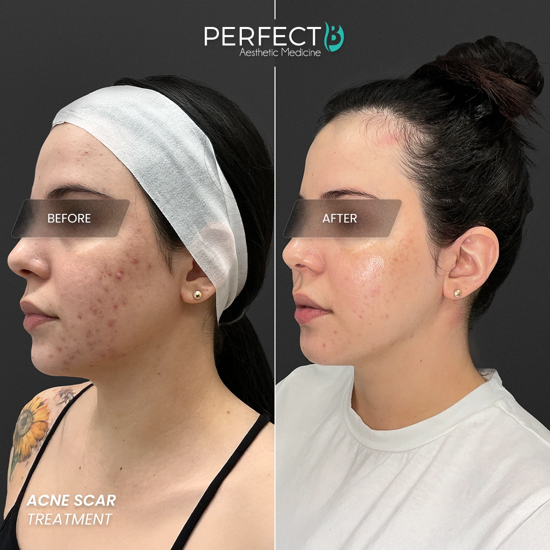Perfect B - Results Image - [Acne Treatment] 4002 - 1080 x 1080