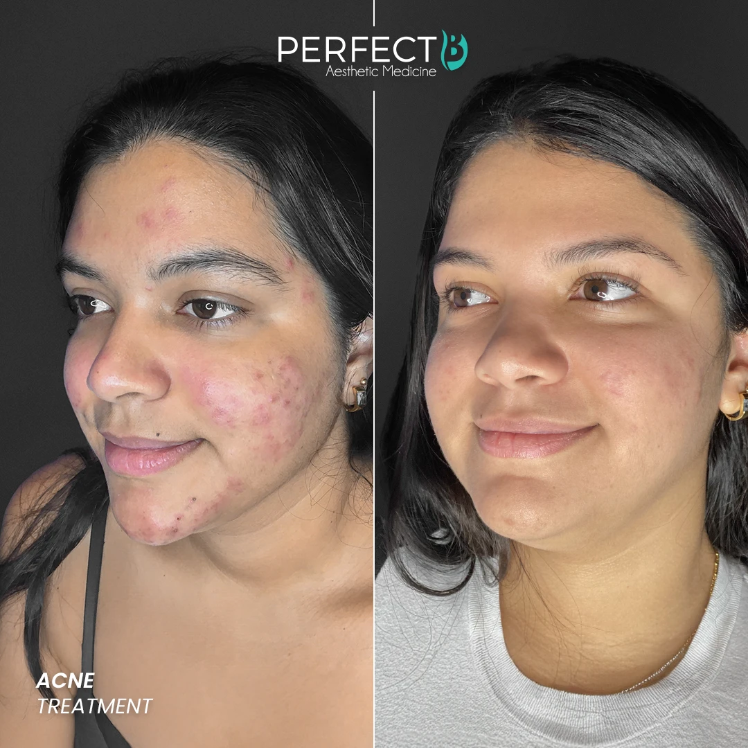 Perfect B - Results Image - [Acne Treatment] 4005 - 1080 x 1080