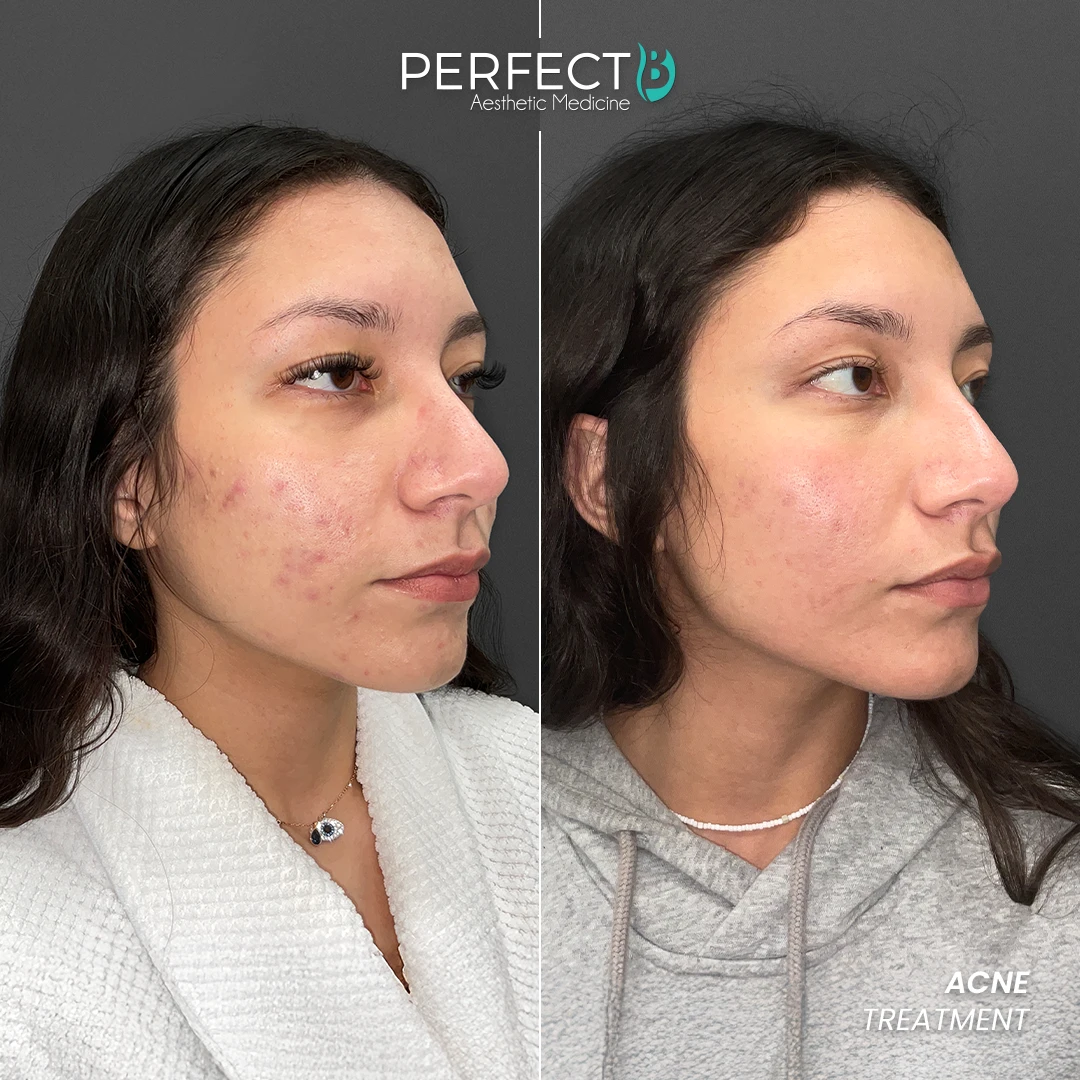 Perfect B - Results Image - [Acne Treatment] 4006 - 1080 x 1080