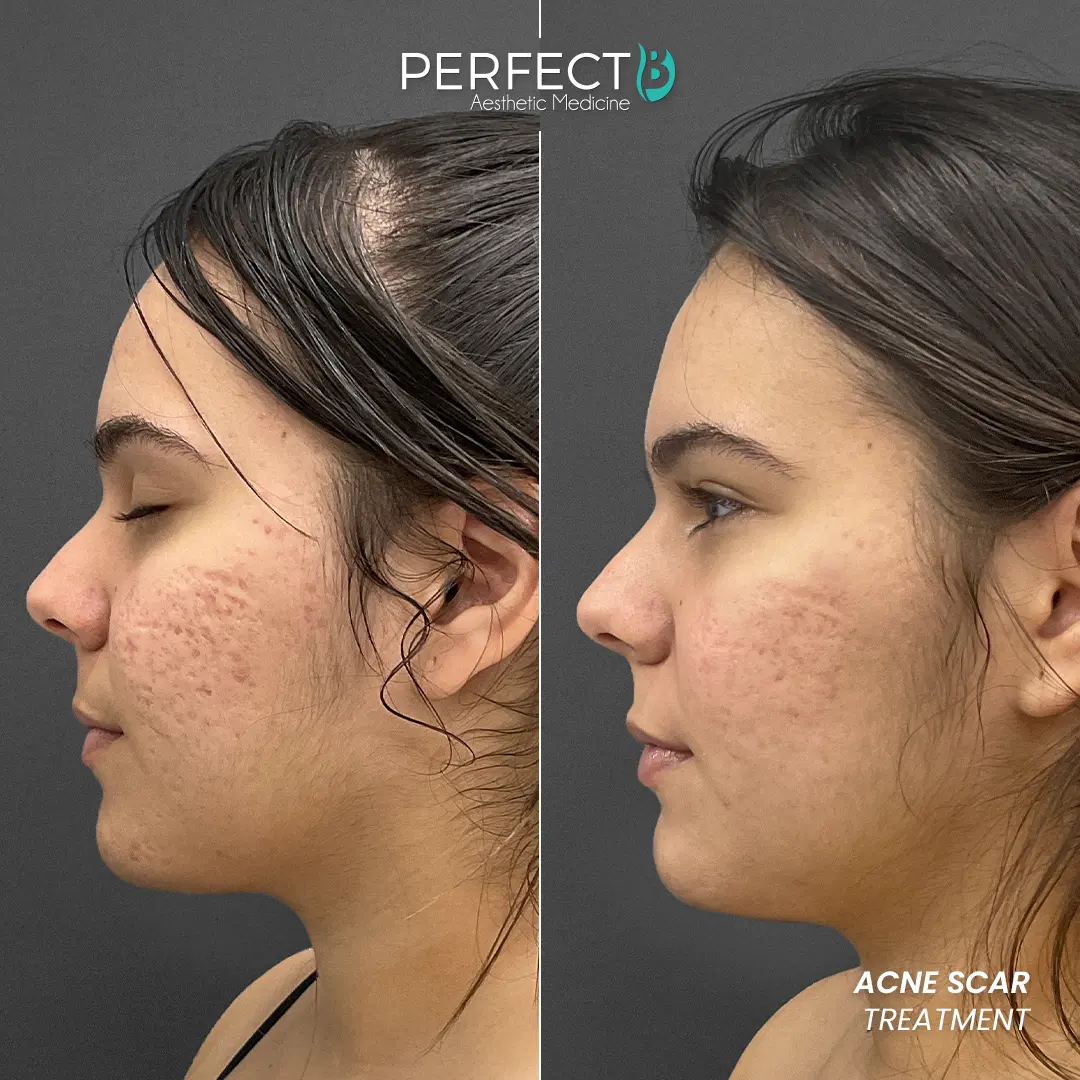 Perfect B - Results Image - [Acne Treatment] 4009 - 1080 x 1080