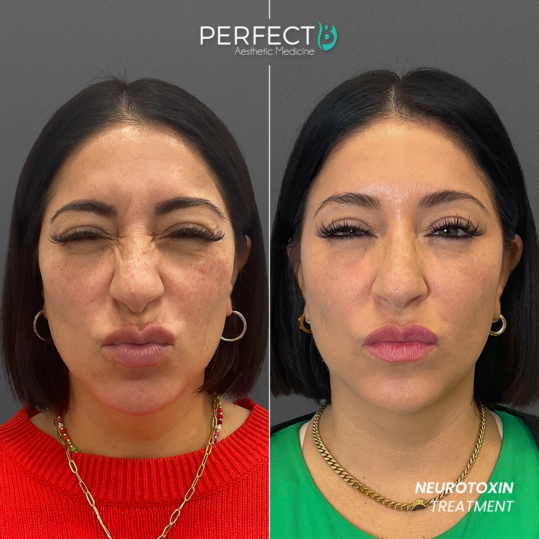 Perfect B - Results Image - [Neurotoxin Treatment] 4000 - 1080 x 1080