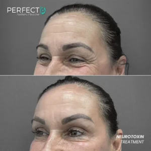 Perfect B - Results Image - [Neurotoxin Treatment] 4006 - 1080 x 1080