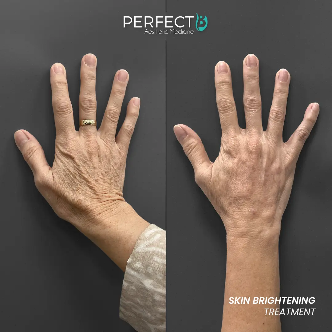 Perfect B - Results Image - [Skin Brightening] 4006 B - 1080 x 1080