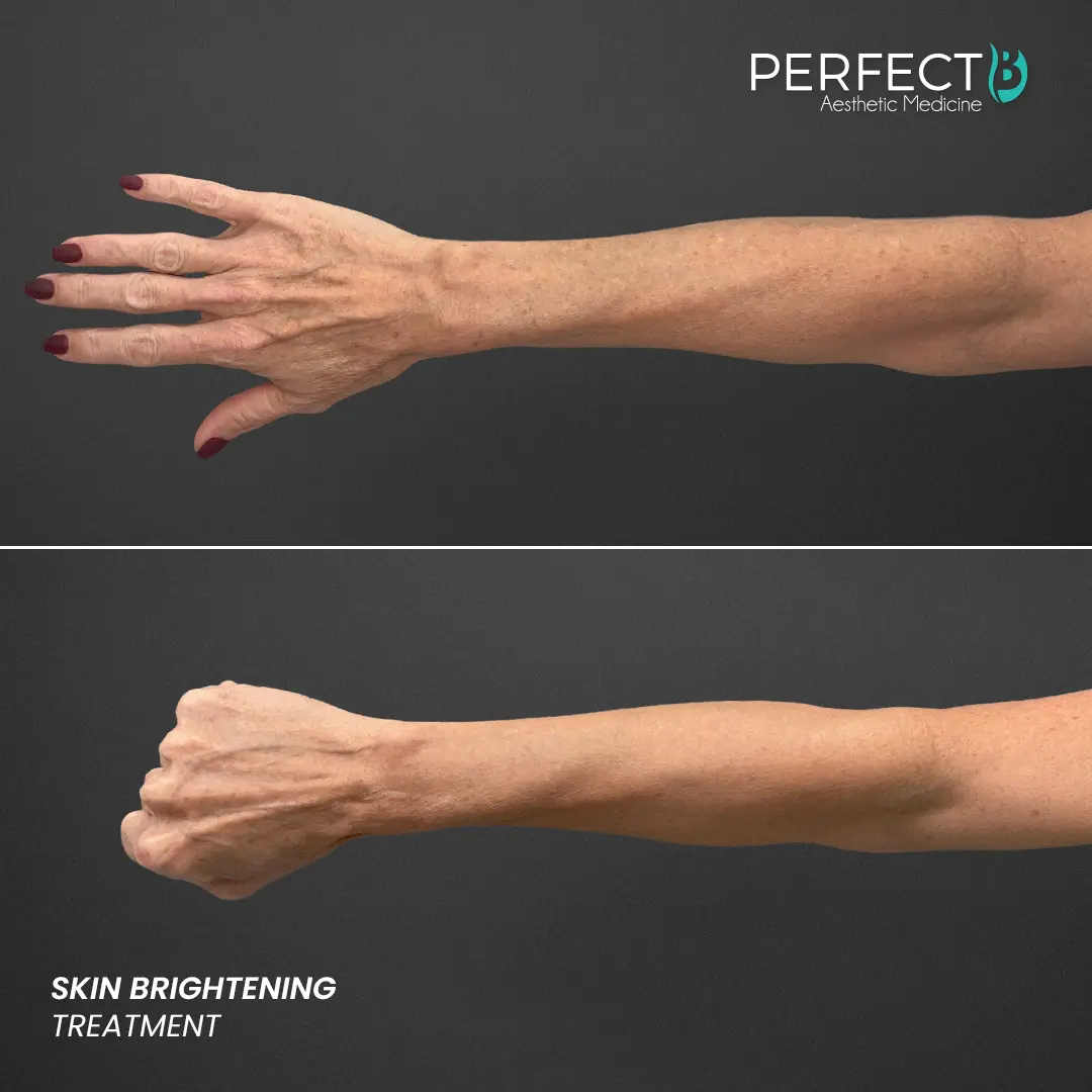 Perfect B - Results Image - [Skin Brightening] 4515 - 1080 x 1080