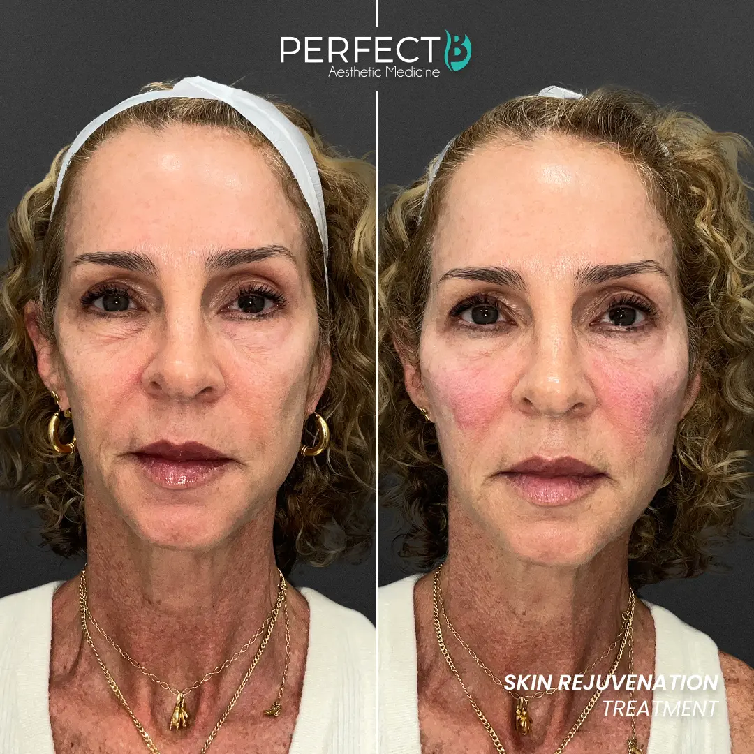 Perfect B - Results Image - [Skin Rejuvenation] 4007 - 1080 x 1080