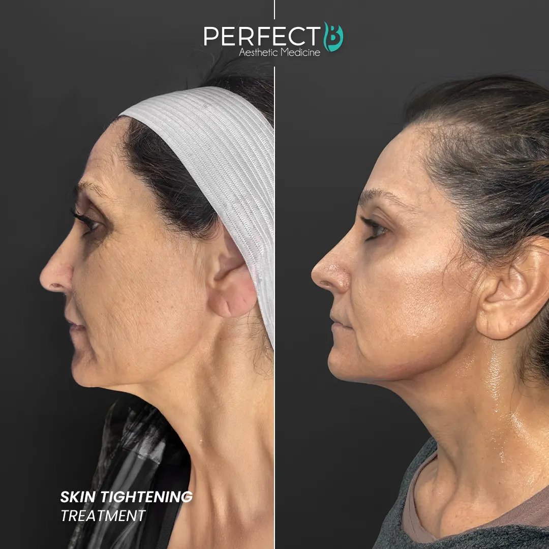 Perfect B - Results Image - [Skin Tightening] 4002 - 1080 x 1080