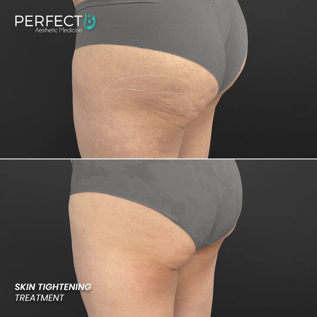 Perfect B - Results Image - [Skin Tightening] 4003 - 1080 x 1080