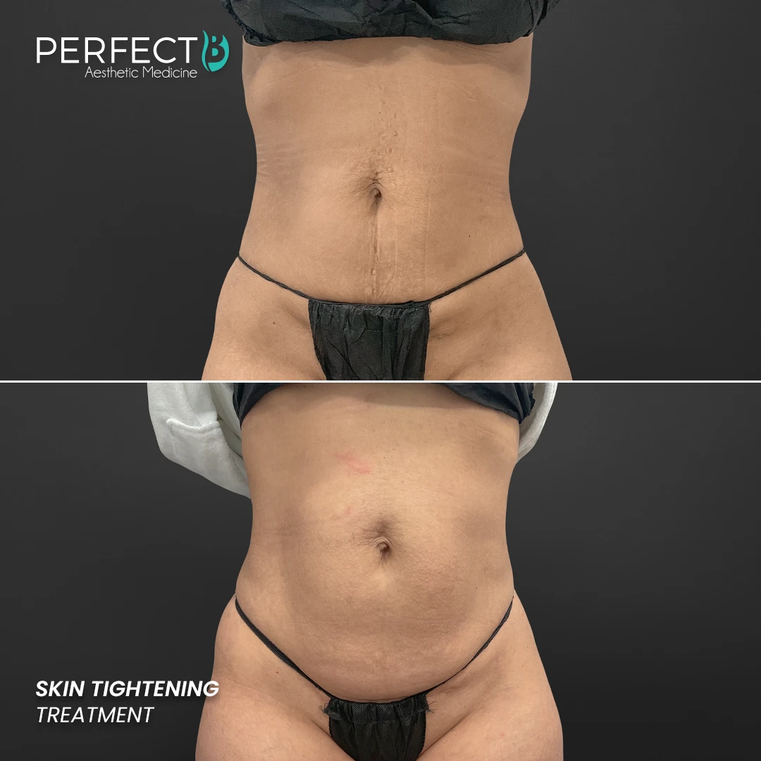 Perfect B - Results Image - [Skin Tightening] Case 4004 - 1080 x 1080