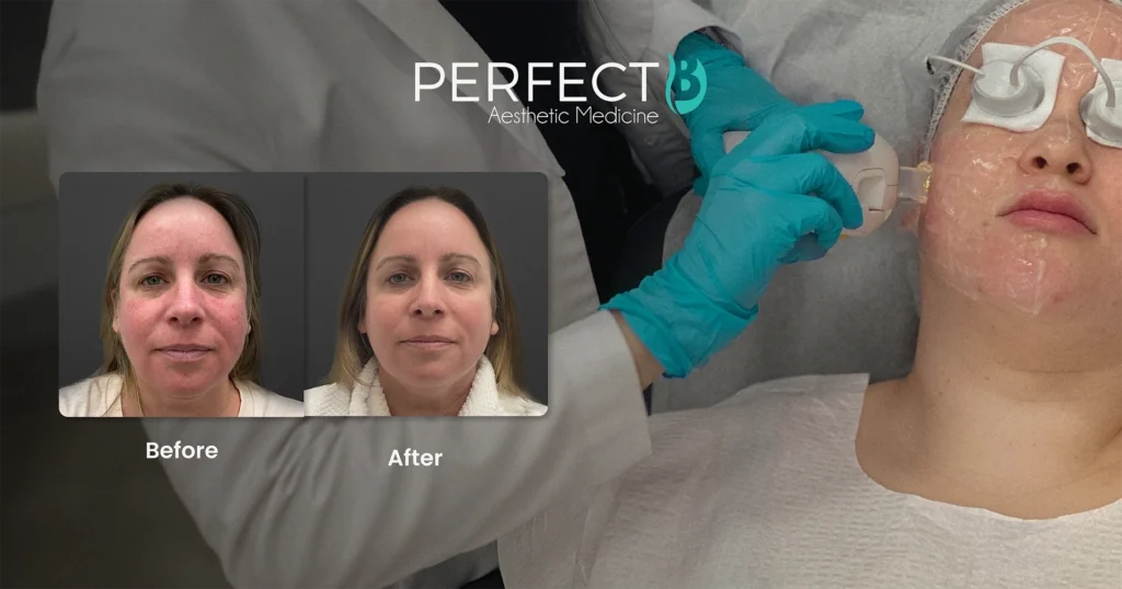 Rosacea treatment at Perfect B, medical aesthetics clinic in Doral, Miami, FL