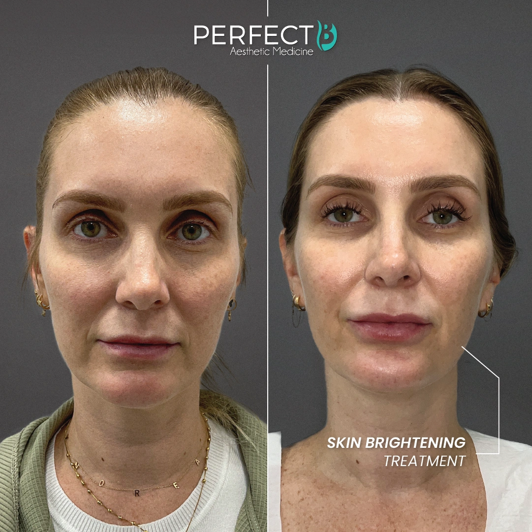 Skin Brightening Treatment - Perfect B - Results Image - Case 7002 - 1080 x 1080