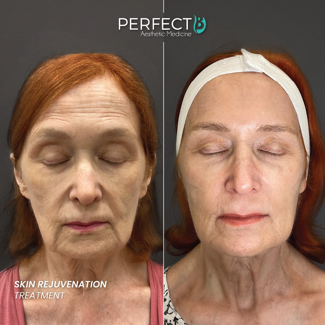 Skin Rejuvenation Treatment - Perfect B - Case 9102 - 1080 x 1080