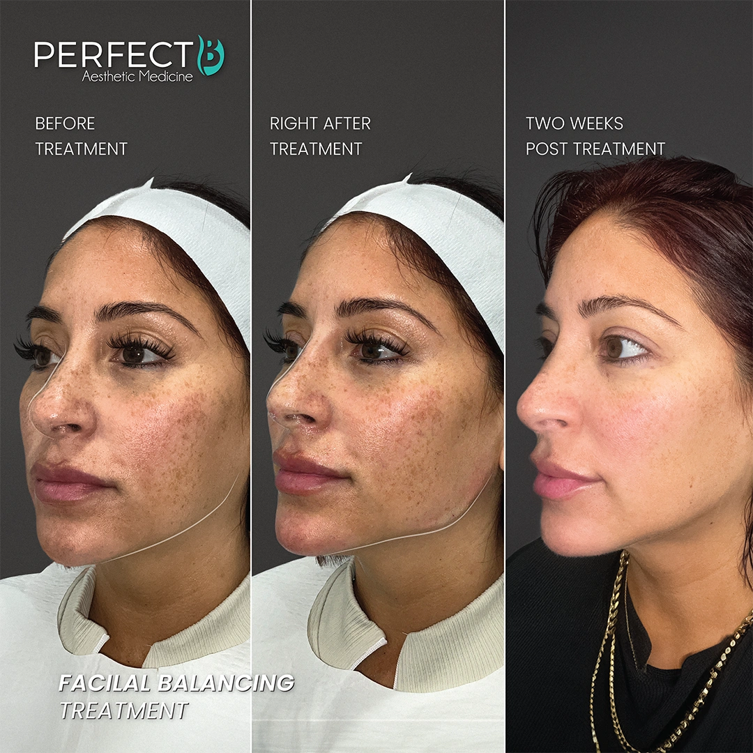 Skin Tightening Treatment - Perfect B - Results Image - Case 9300 - 1080 x 1080