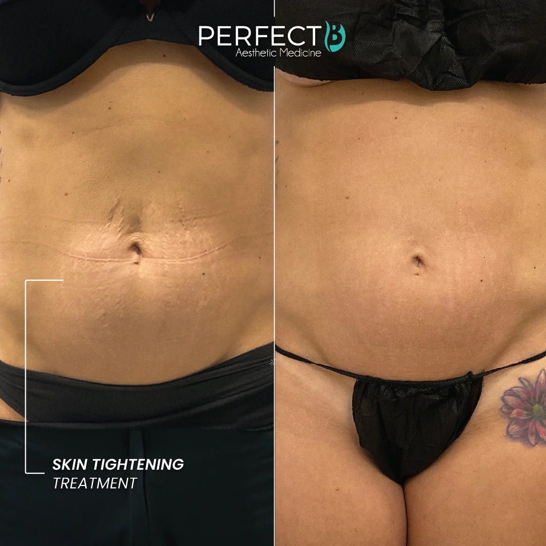 Skin Tightening Treatment - Perfect B - Results Image - Case 9301 - 1080 x 1080