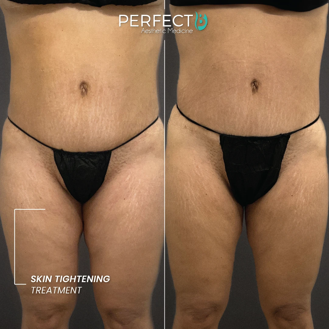 Skin Tightening Treatment - Perfect B - Results Image - Case 9302 - 1080 x 1080