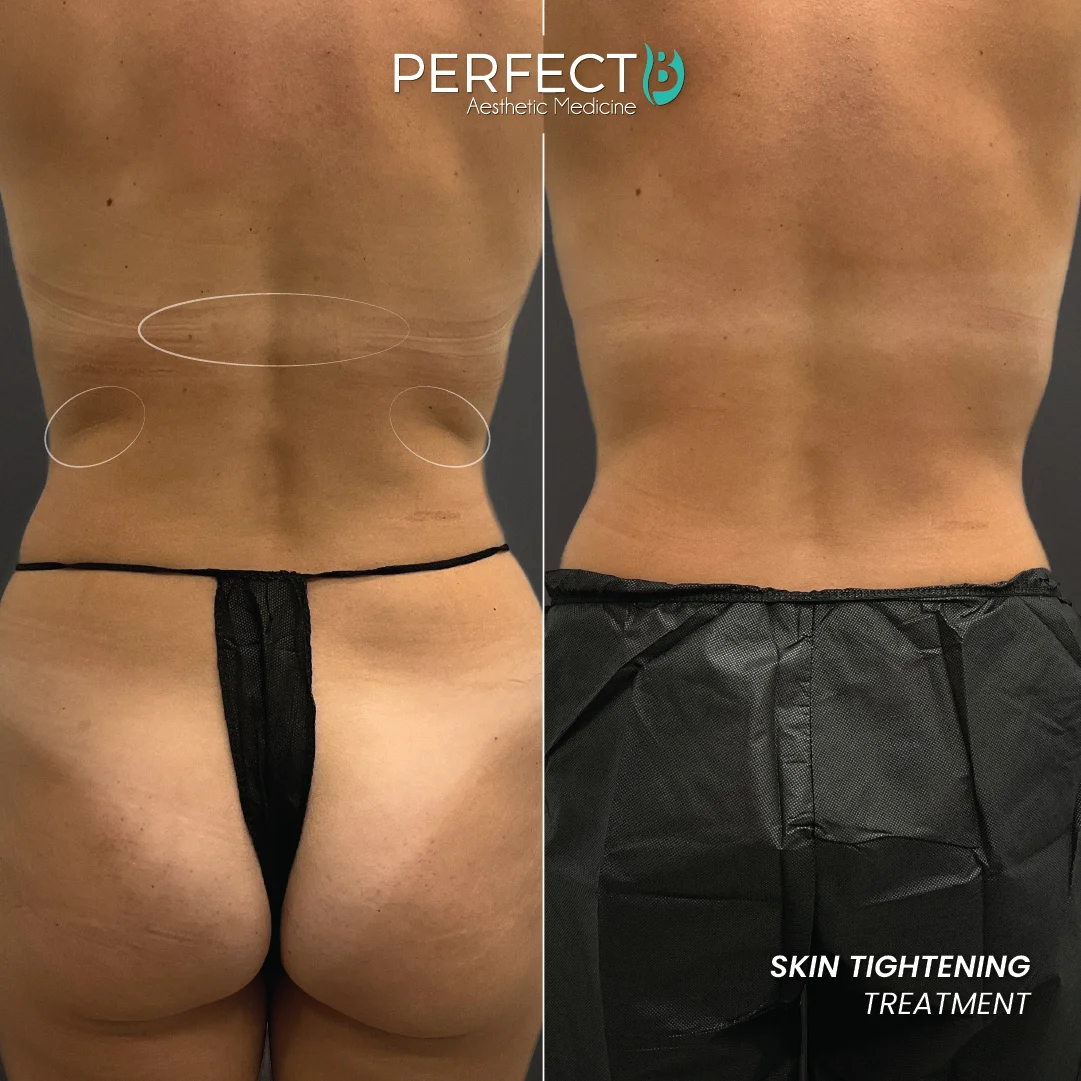 Skin Tightening Treatment - Perfect B - Results Image - Case 9304 - 1080 x 1080