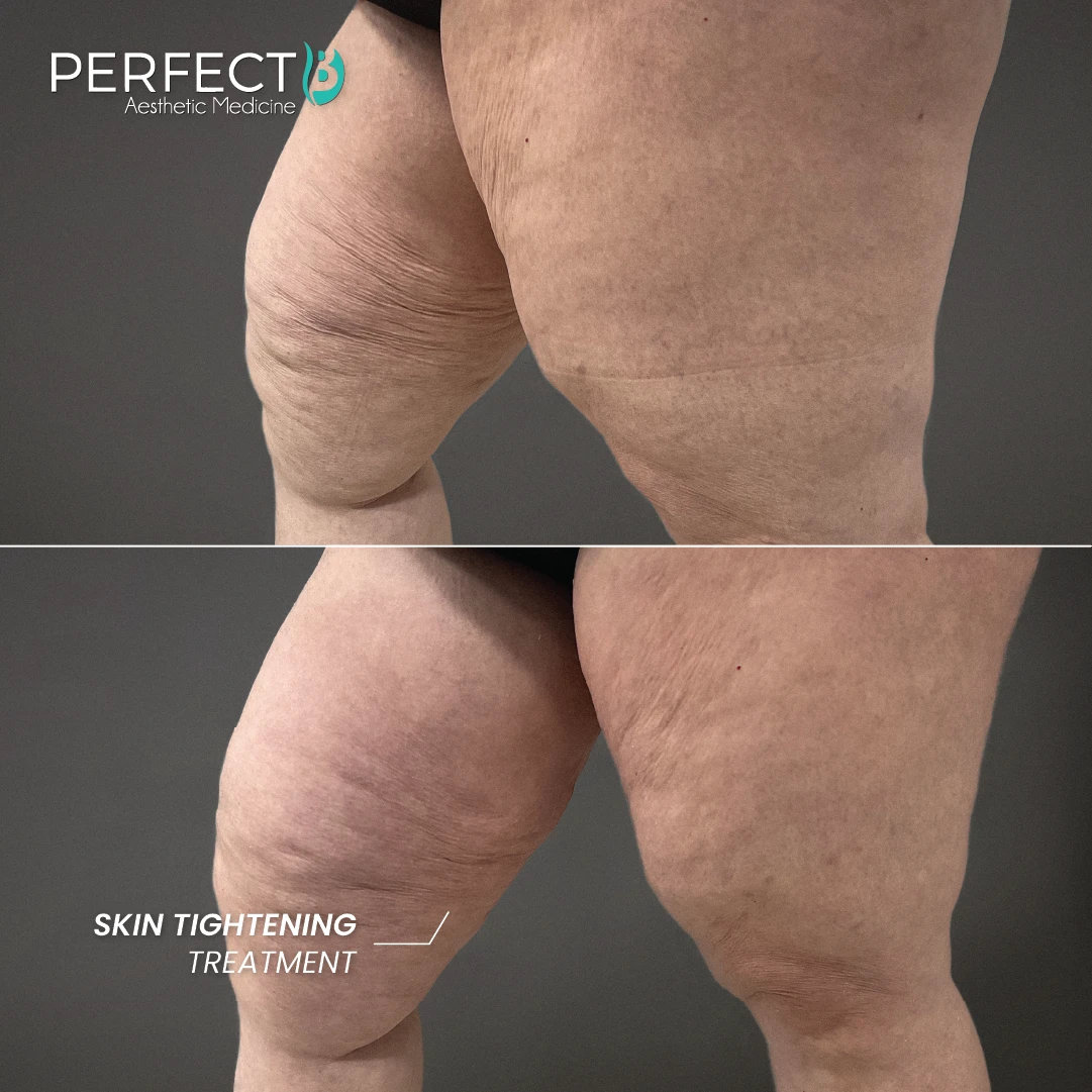 Skin Tightening Treatment - Perfect B - Results Image - Case 9306 - 1080 x 1080