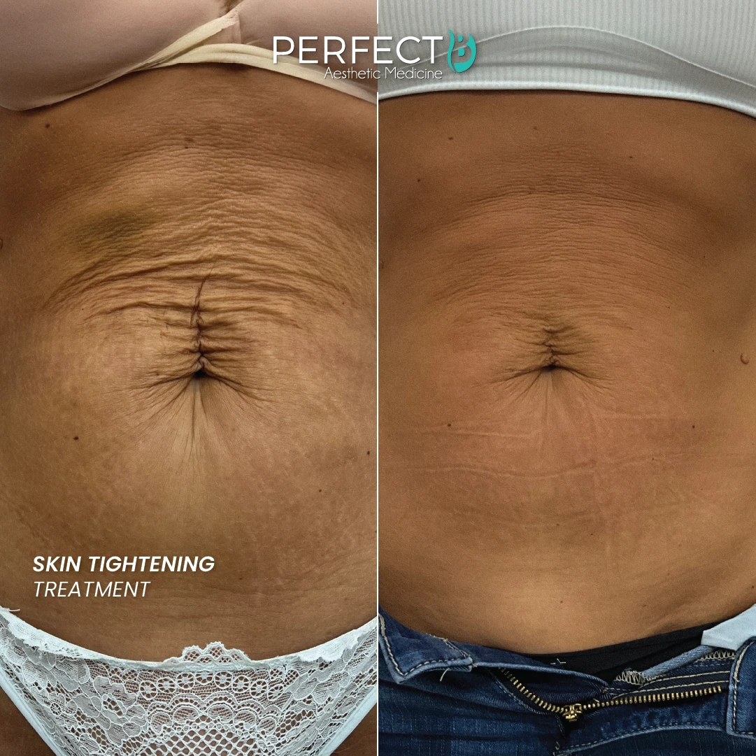 Skin Tightening Treatment - Perfect B - Results Picture - Case 5010 - 1080 x 1080