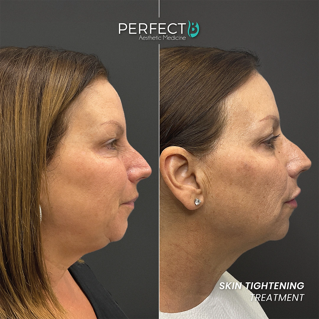 Skin Tihtening Treatment - Perfect B - Results Image - Case 9305 DC - 1080 x 1080