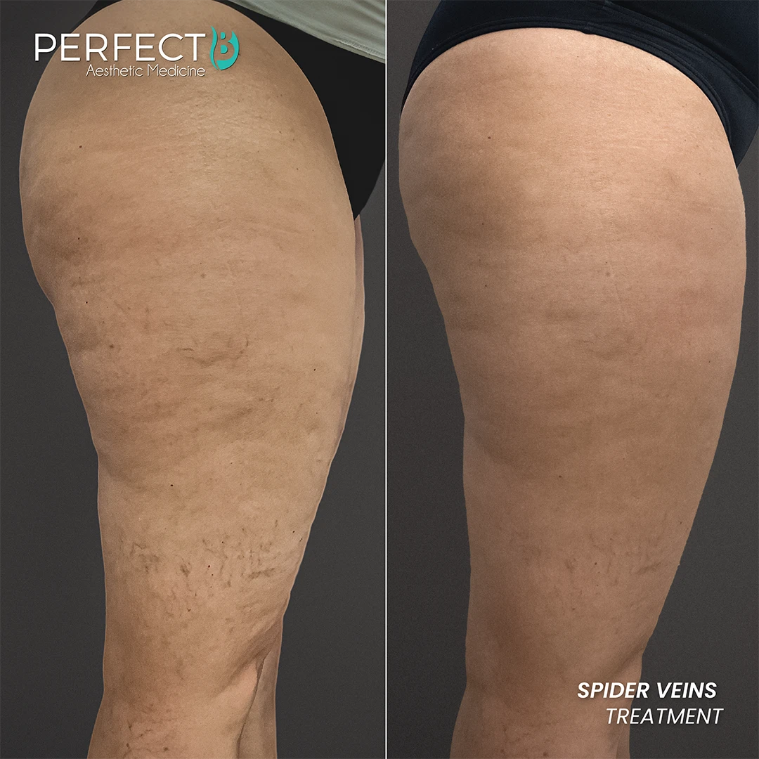 Spider Veins Treatment - Perfect B - Results Image - Case 9703 - 1080 x 1080