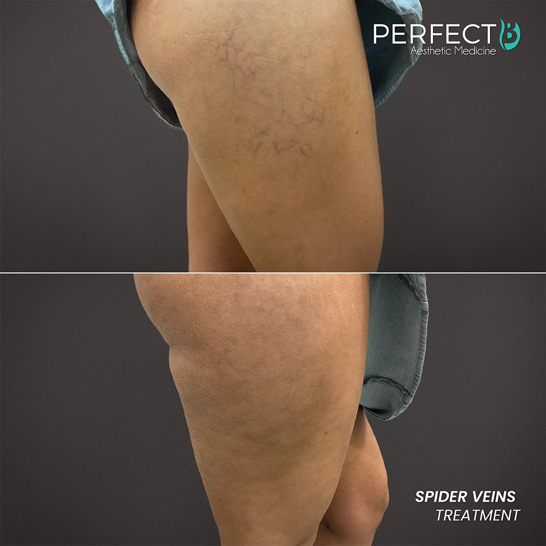 Spider Veins Treatment - Perfect B - Results Image - Case 9704 - 1080 x 1080