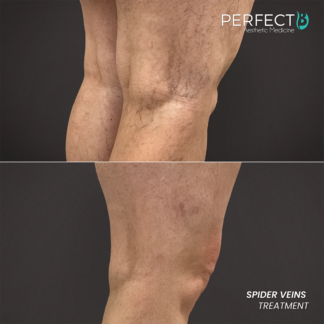 Spider Veins Treatment - Perfect B - Results Image - Case 9705 - 1080 x 1080