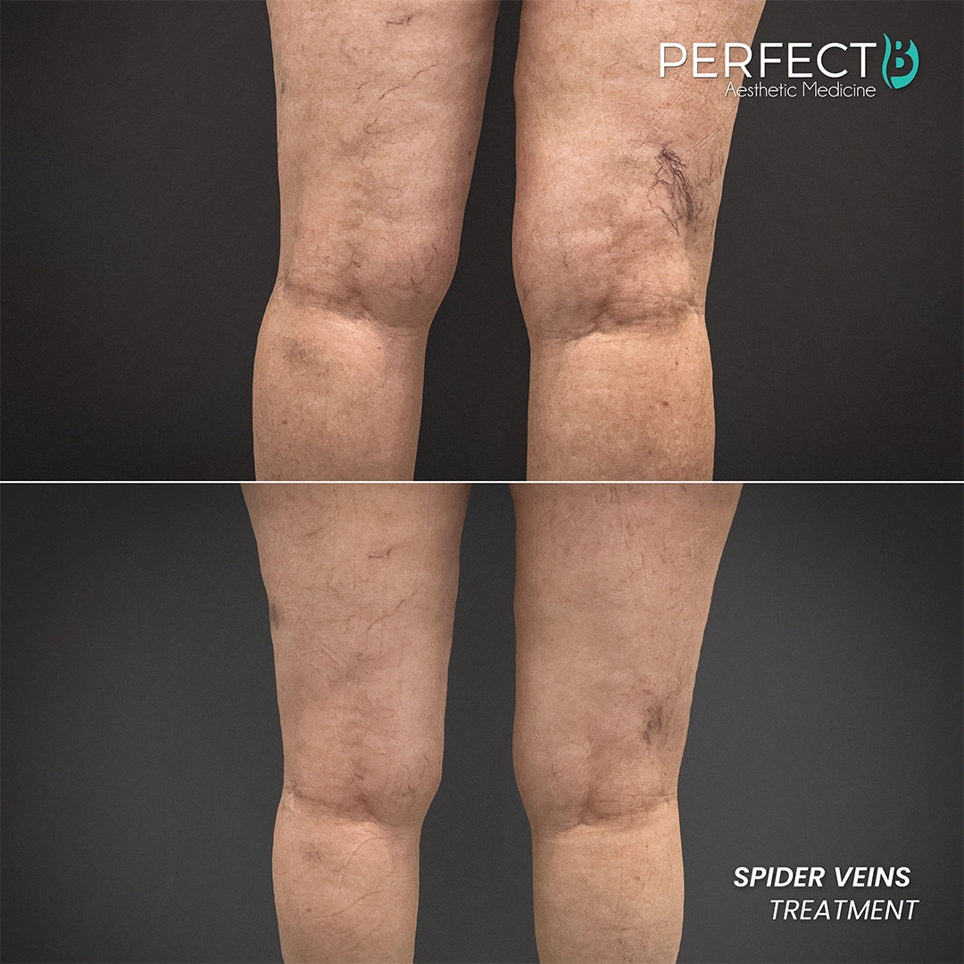 Spider Veins Treatment - Perfect B - Results Image - Case 9706 - 1080 x 1080