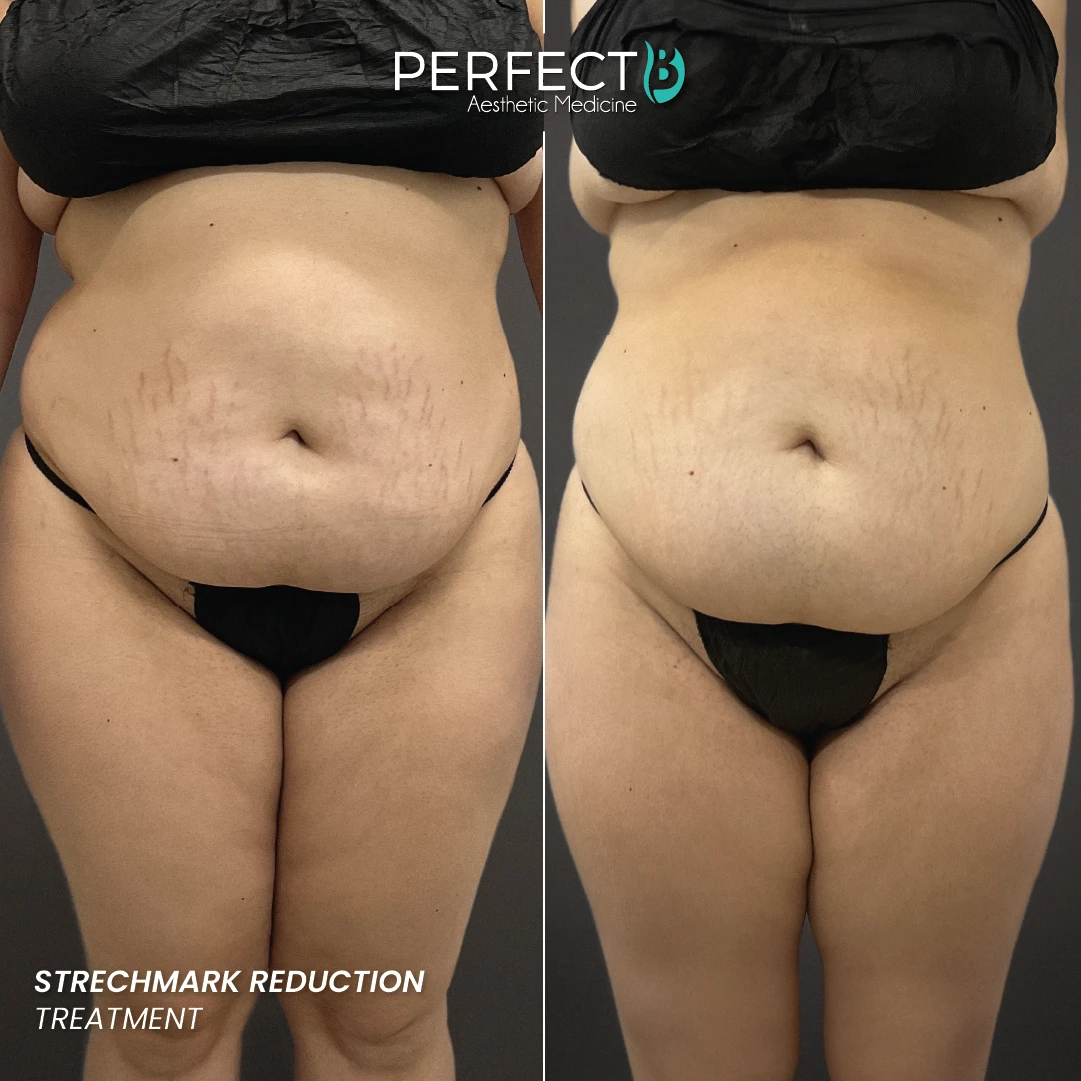 Strechmark Reduction Treatment - Perfect B - Results Image - Case A 9410 - 1080 x 1080