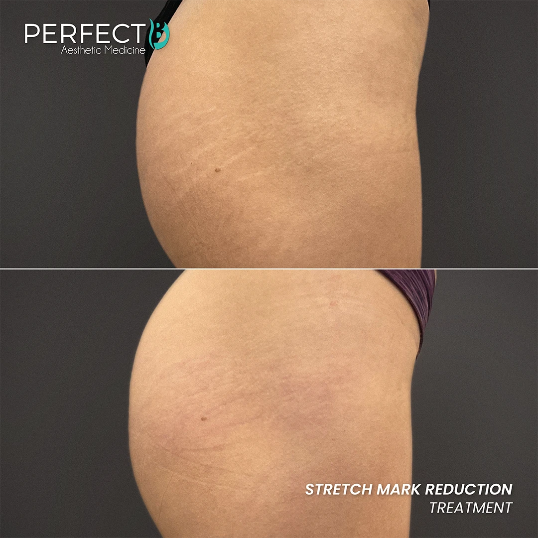 Stretch Mark Reduction Treatment - Perfect B - Results Image - Case 9403 - 1080 x 1080