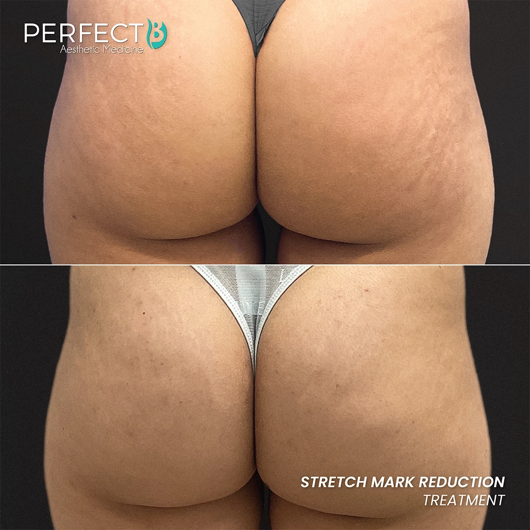 Stretch Mark Reduction Treatment - Perfect B - Results Image - Case 9405 - 1080 x 1080
