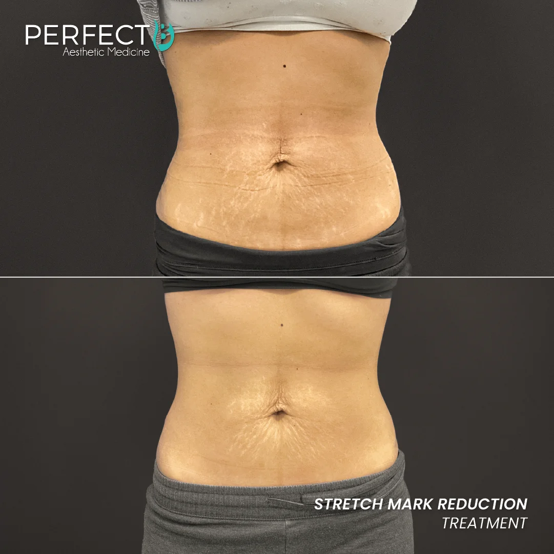Stretch Marks Reduction Treatment - Perfect B - Results Image - Case 9402 - 1080 x 1080