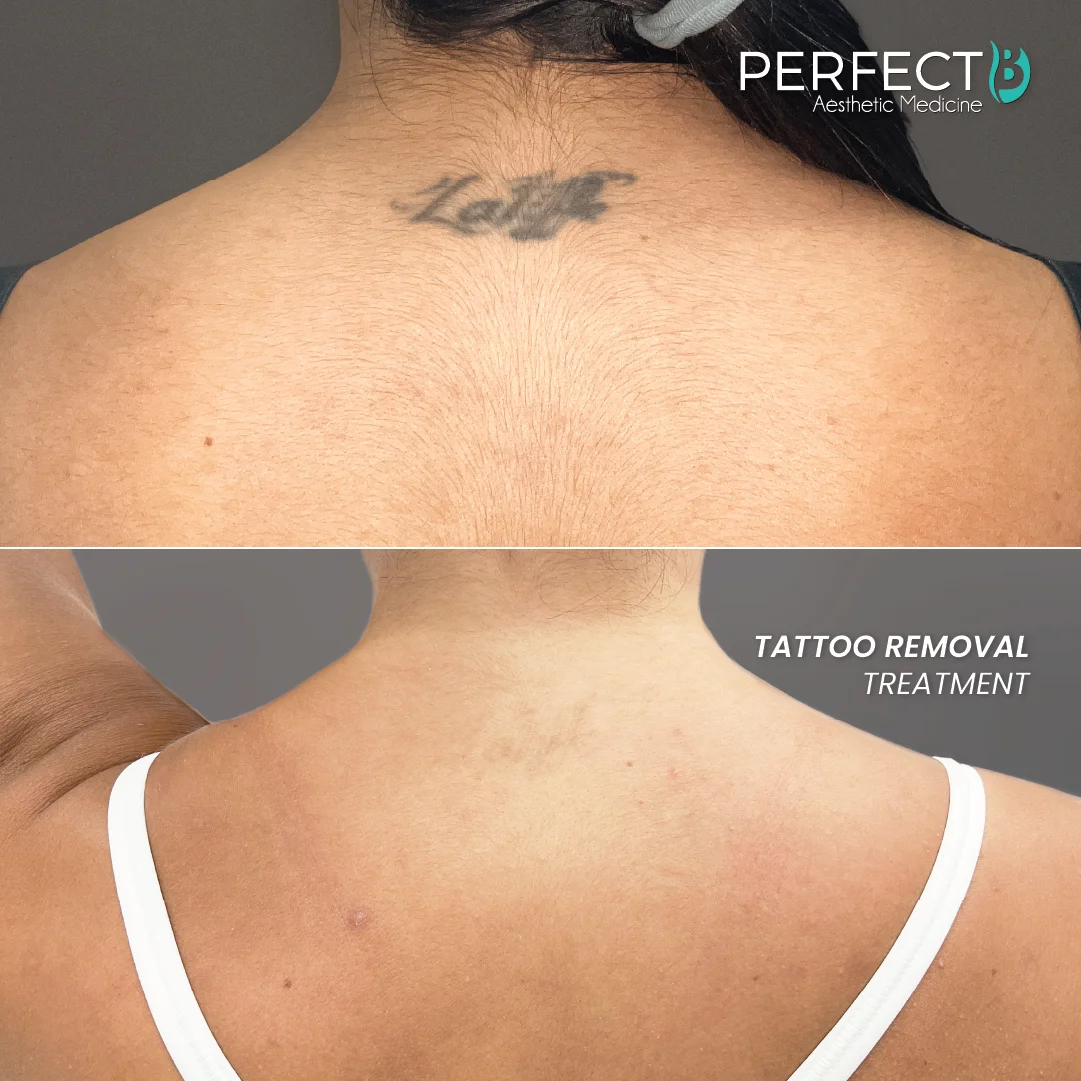 Tattoo Removal Treatment - Perfect B - Results Image - Case 9501 - 1080 x 1080