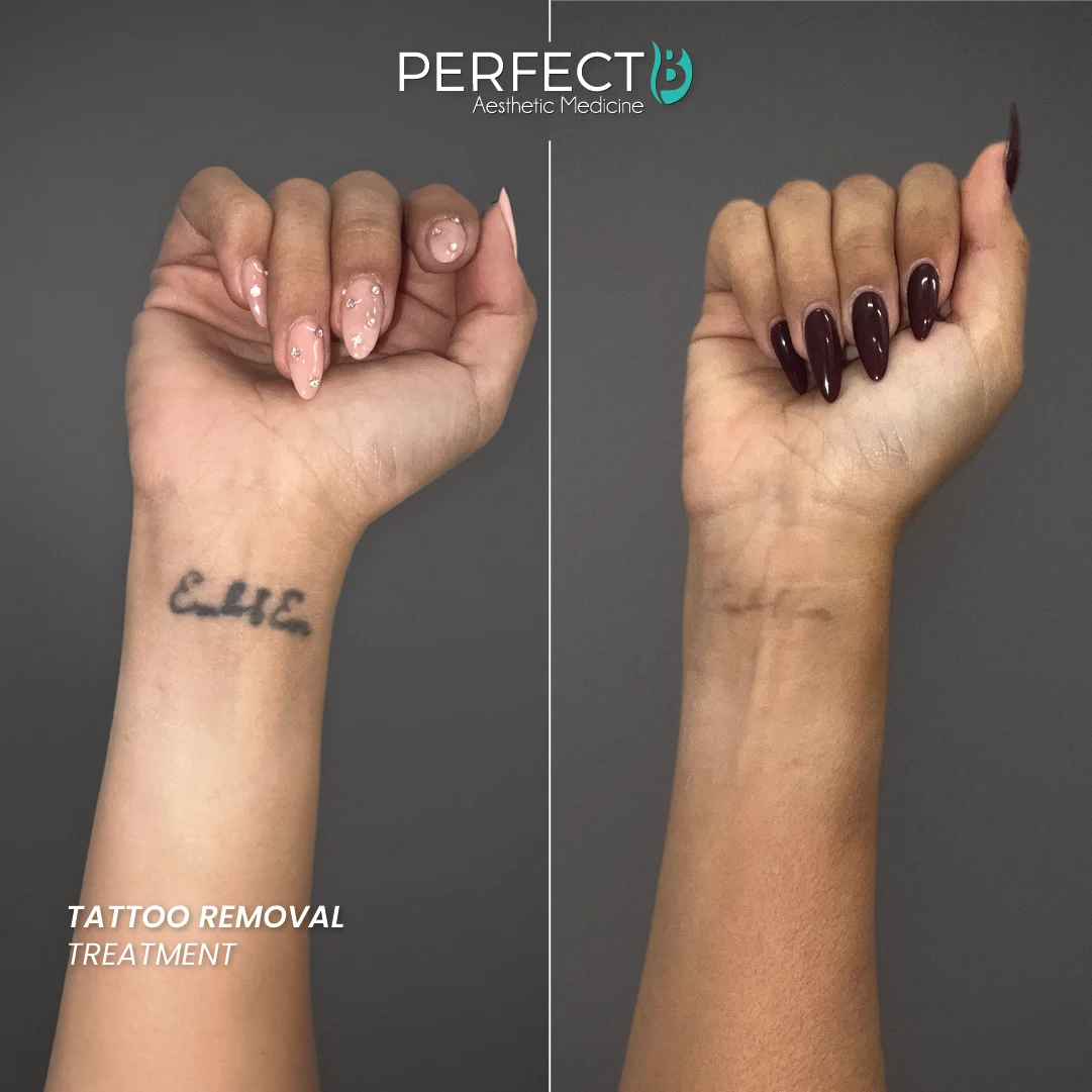 Tattoo Removal Treatment - Perfect B - Results Image - Case 9502- 1080 x 1080