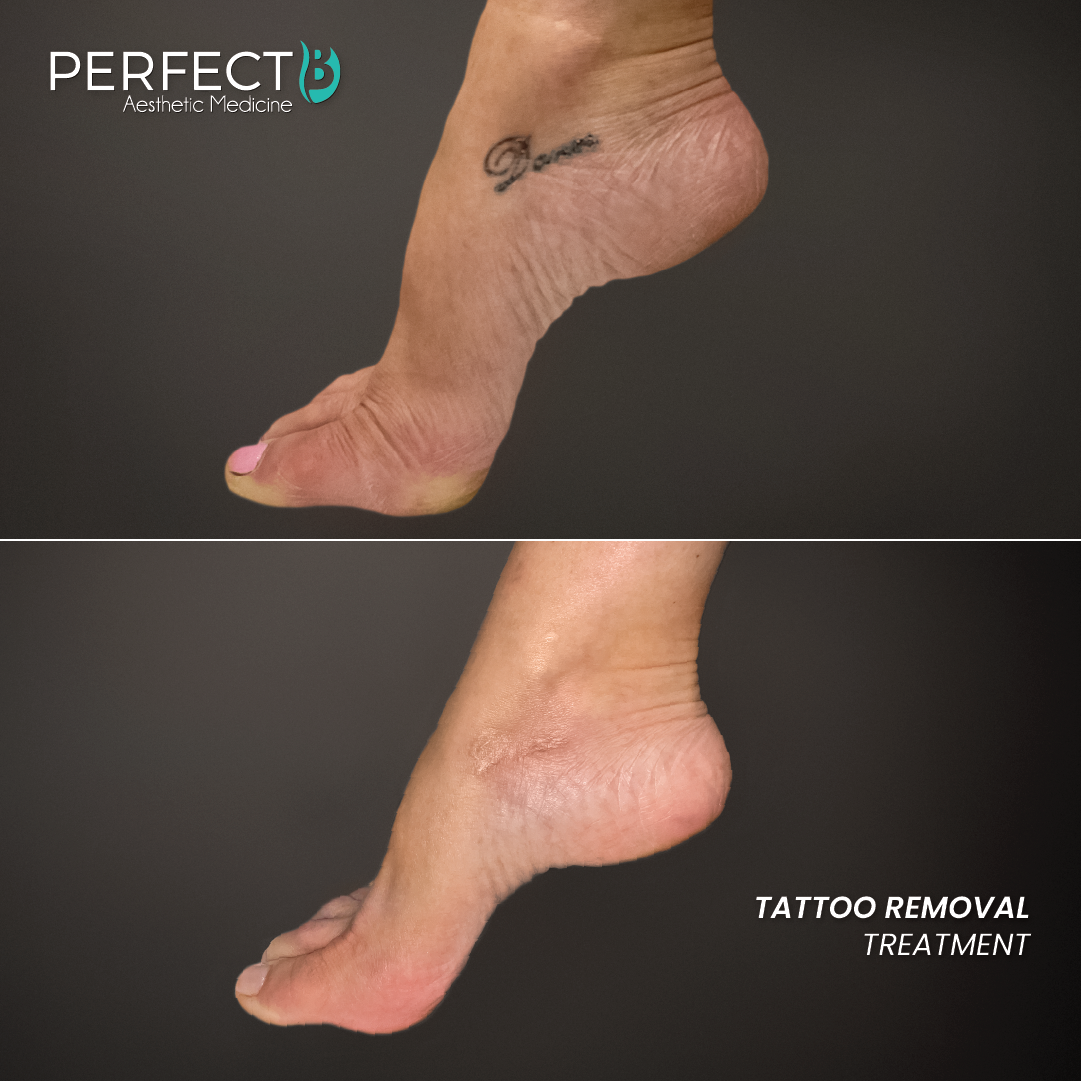 Tattoo Removal Treatment - Perfect B - Results Image - Case 9502 - 1080 x 1080