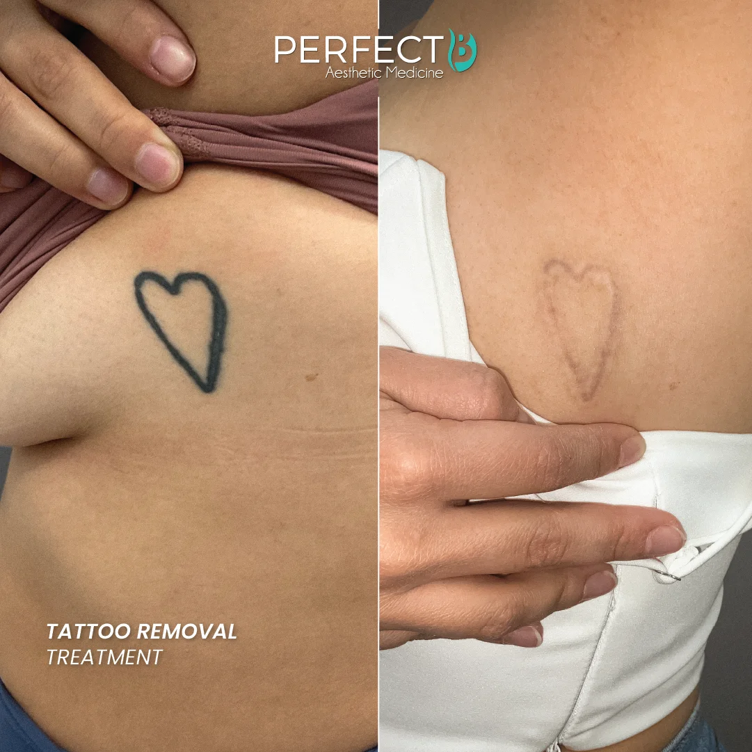 Tattoo Removal Treatment - Perfect B - Results Image - Case 9514 - 1080 x 1080