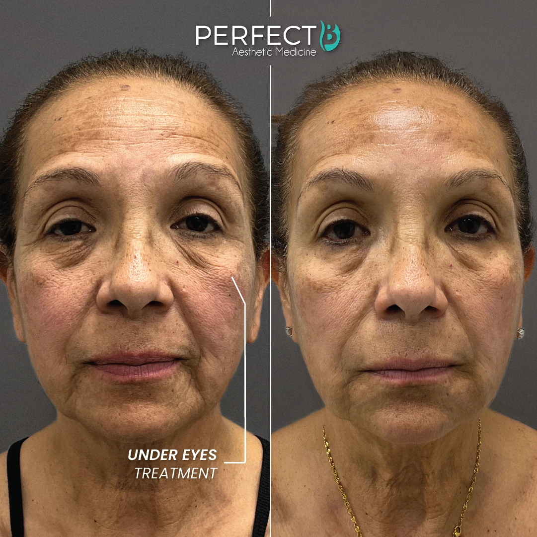 Under Eyes Treatment - Perfect B - Case 5001 - Results Picture - 1080 x 1080