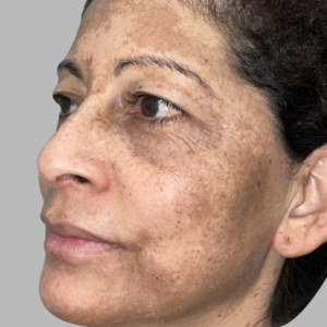 Close-up of facial melasma and hyperpigmentation at Perfect B, medical aesthetics clinic in Doral, Miami, FL