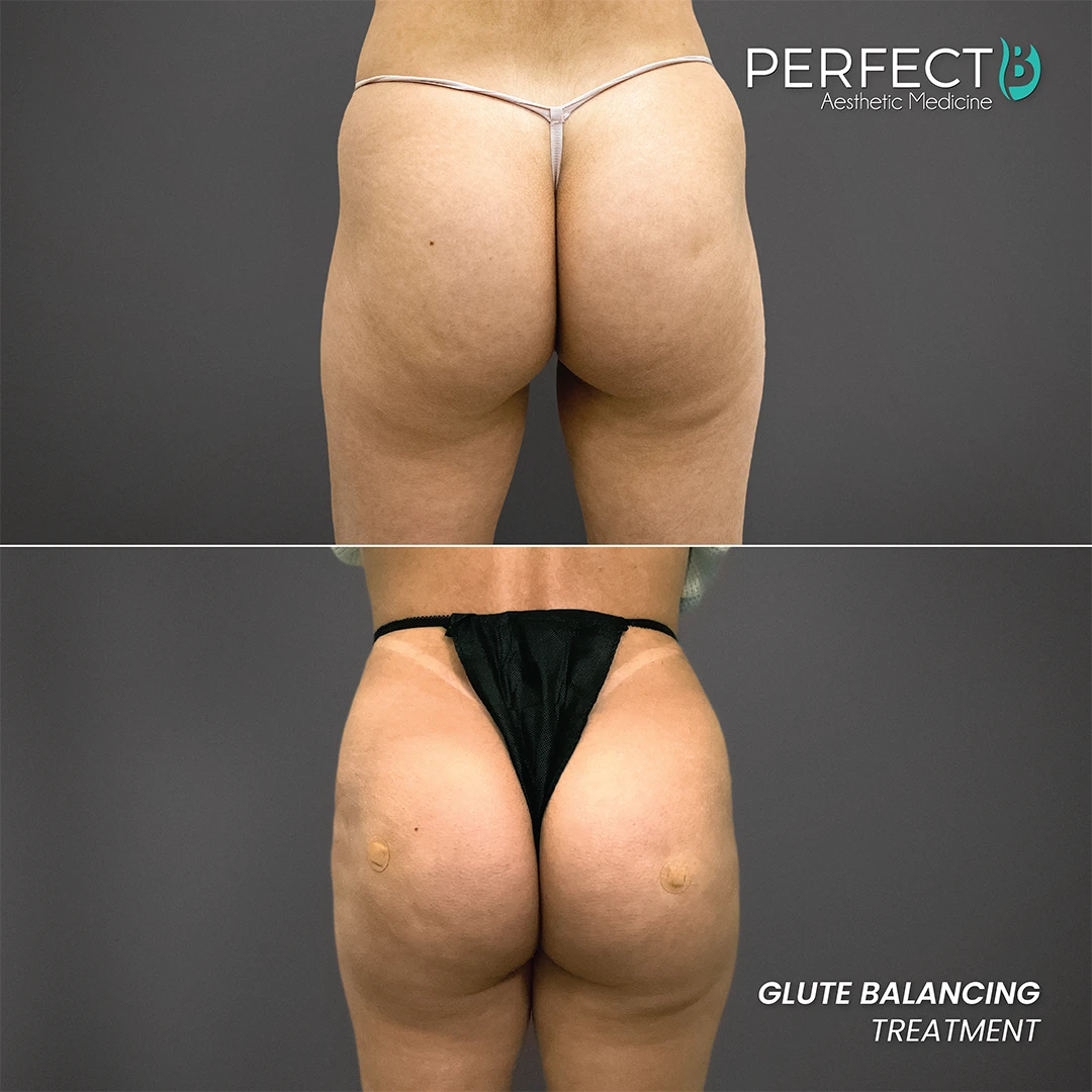 Glute Balancing Treatment - Perfect B - Results Image - Case 6201 - 1080 x 1080