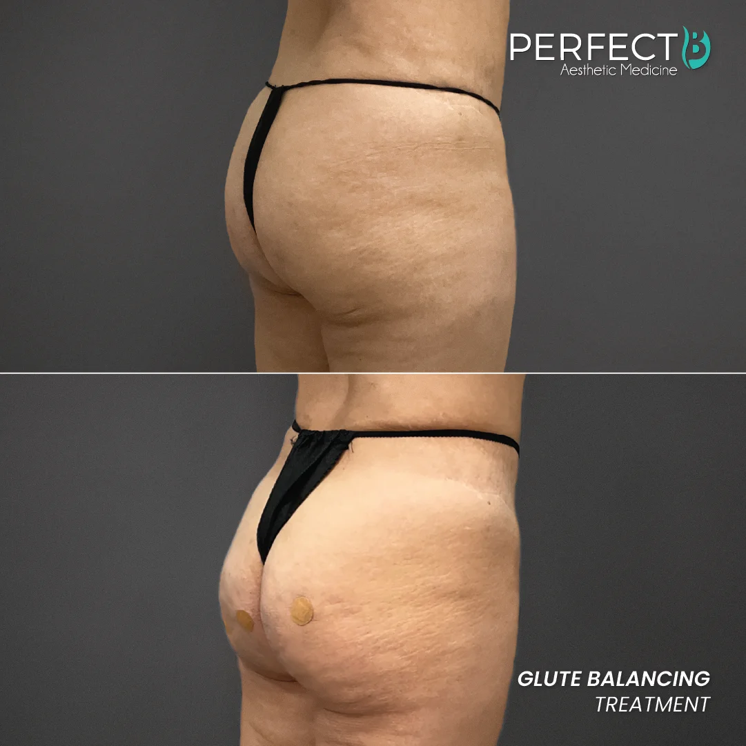 Glute Balancing Treatment - Perfect B - Results Image - Case 6203 - 1080 x 1080