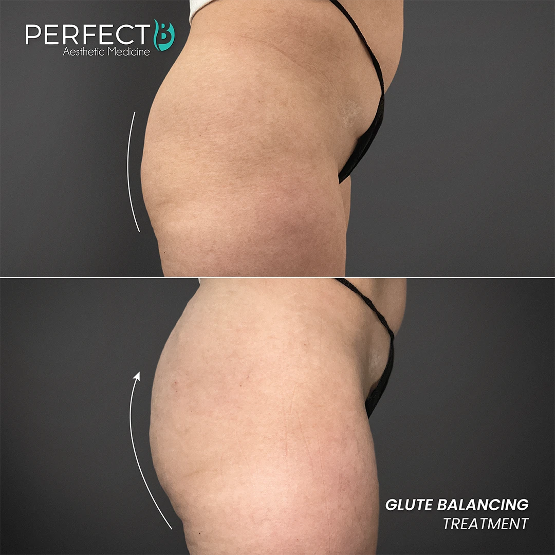 Glute Balancing Treatment - Perfect B - Results Image - Case 6204 - 1080 x 1080