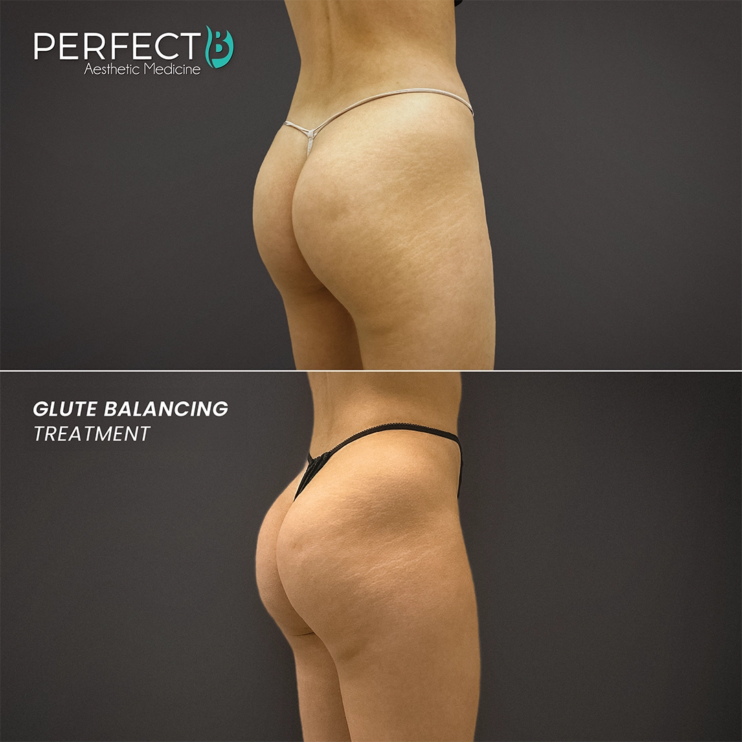 Glute Balancing Treatment - Perfect B - Results Image - Case 8247 - 1080 x 1080
