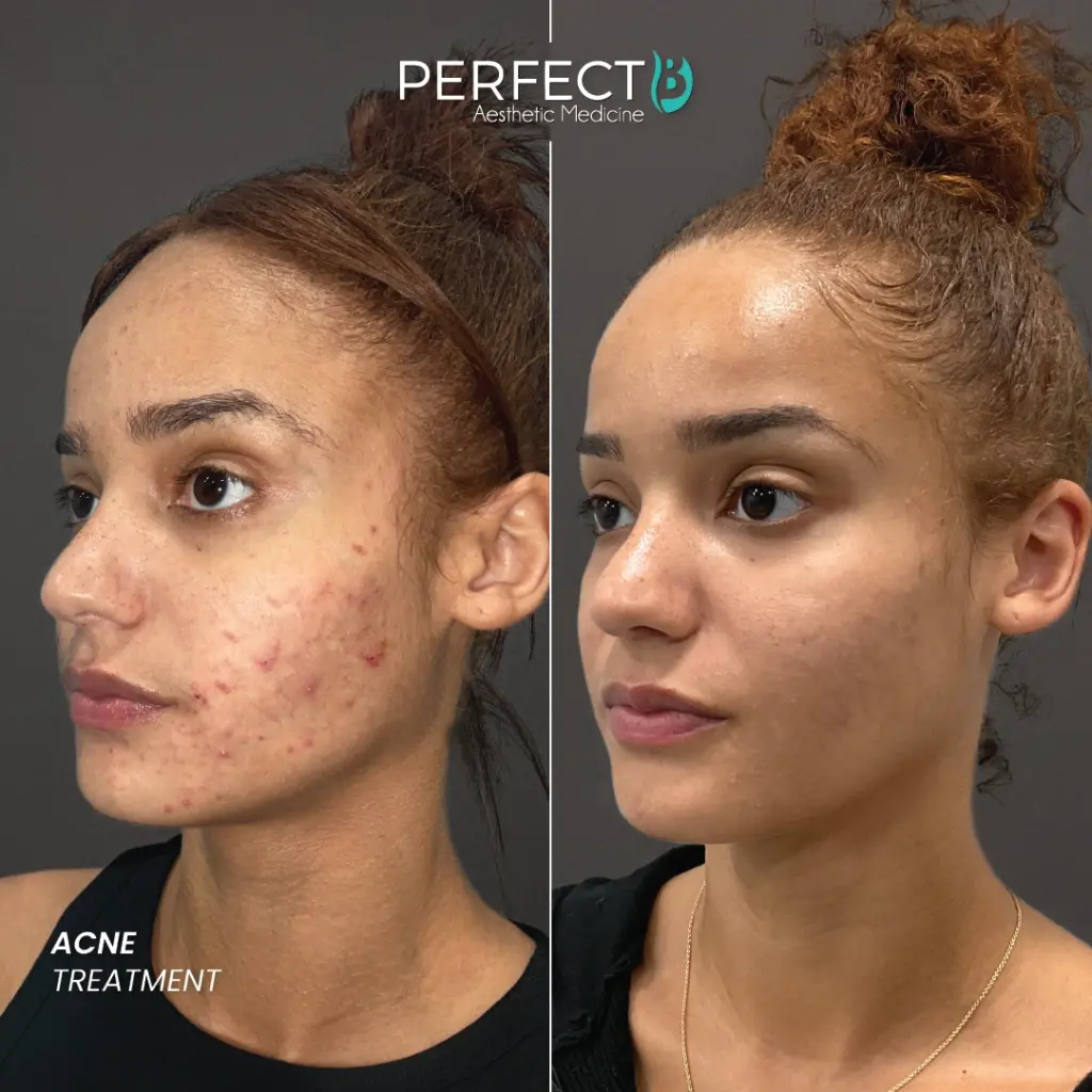 Getting rid of acne treatment, before and after, real results
